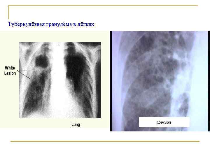 Туберкулёзная гранулёма в лёгких 