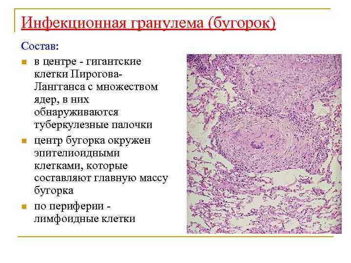 Инфекционная гранулема (бугорок) Состав: n в центре - гигантские клетки Пирогова. Лангганса с множеством