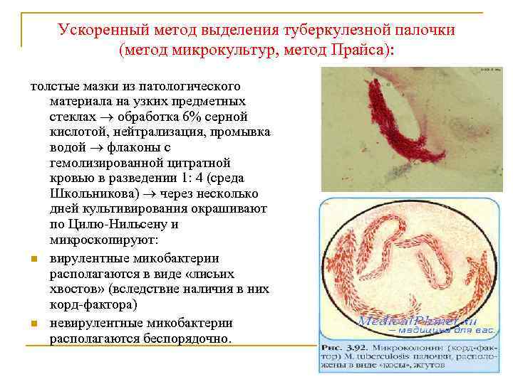 Ускоренный метод выделения туберкулезной палочки (метод микрокультур, метод Прайса): толстые мазки из патологического материала