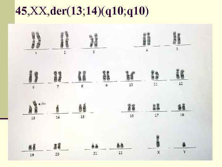45, ХХ, der(13; 14)(q 10; q 10) 
