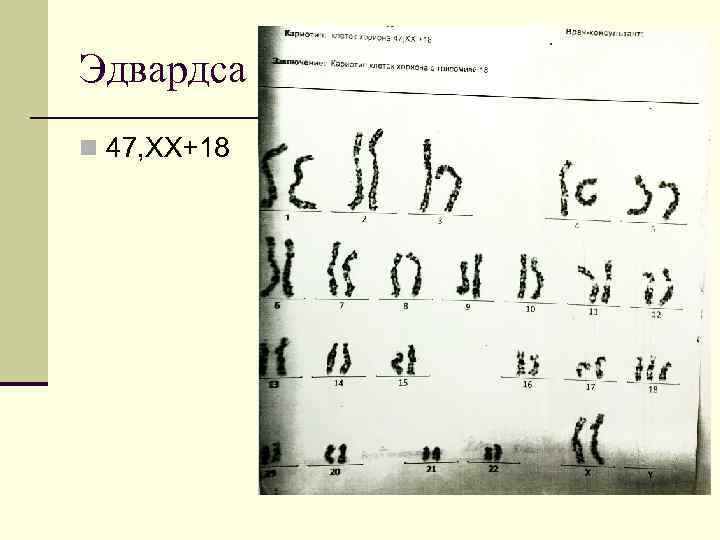 Эдвардса n 47, XX+18 