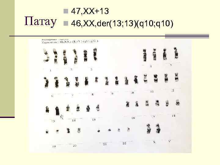 Патау n 47, XX+13 n 46, XX, der(13; 13)(q 10; q 10) 