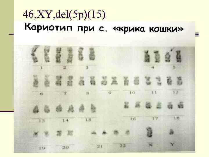 46, XY, del(5 p)(15) 