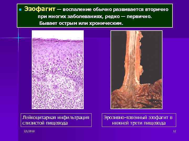 n Эзофагит — воспаление обычно развивается вторично при многих заболеваниях, редко — первично. Бывает