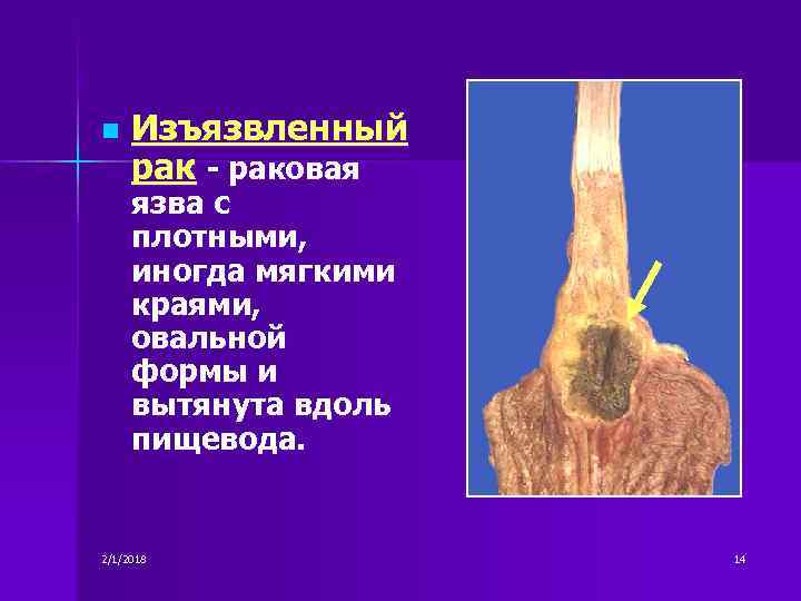 n Изъязвленный раковая язва с плотными, иногда мягкими краями, овальной формы и вытянута вдоль