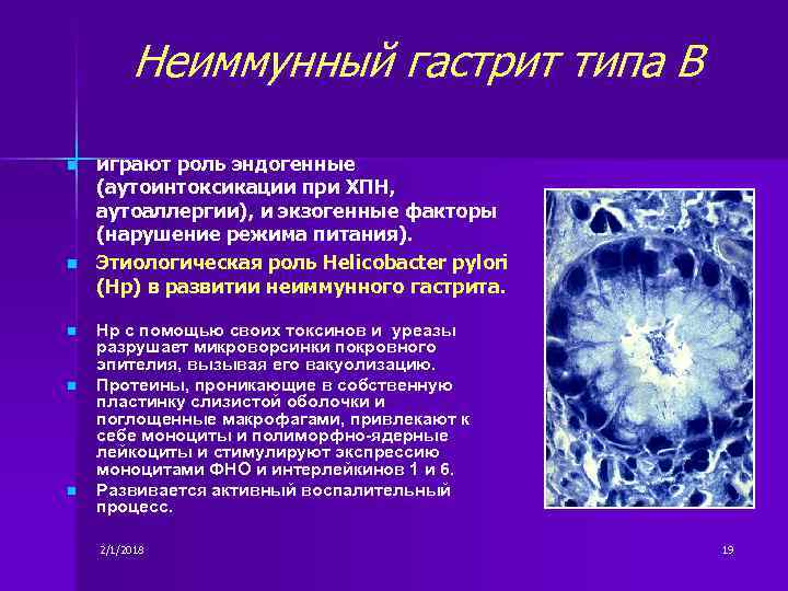 Неиммунный гастрит типа В n n n играют роль эндогенные (аутоинтоксикации при ХПН, аутоаллергии),