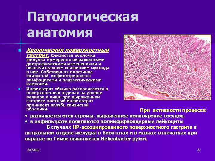 Краткая патологическая анатомия. Хронический гастрит патанатомия. Морфология гастрита патанатомия. Гастрит патанатомия макропрепарат.