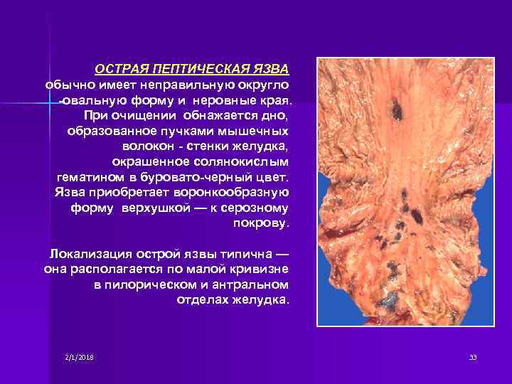ОСТРАЯ ПЕПТИЧЕСКАЯ ЯЗВА обычно имеет неправильную округло -овальную форму и неровные края. При очищении