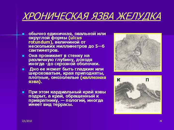 ХРОНИЧЕСКАЯ ЯЗВА ЖЕЛУДКА n n обычно единичная, овальной или округлой формы (ulcus rotundum), величиной