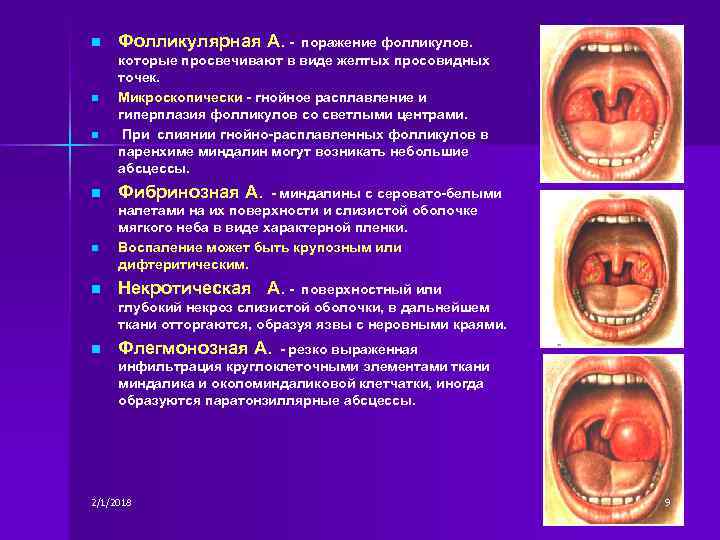 n n n Фолликулярная А. - поражение фолликулов. которые просвечивают в виде желтых просовидных