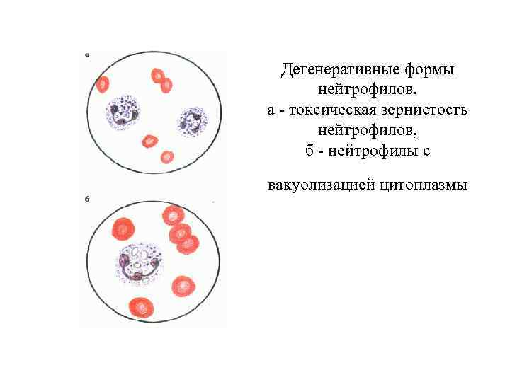 Дегенеративные формы нейтрофилов. а - токсическая зернистость нейтрофилов, б - нейтрофилы с вакуолизацией цитоплазмы