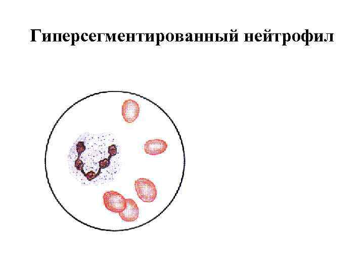 Гиперсегментированный нейтрофил 