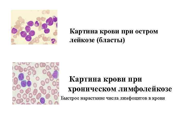 Картина крови при остром лейкозе (бласты) Картина крови при хроническом лимфолейкозе Быстрое нарастание числа