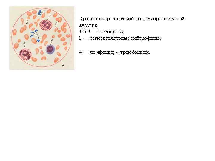 Кровь при хронической постгеморрагической анемии: 1 и 2 — шизоциты; 3 — сегментоядерные нейтрофилы;