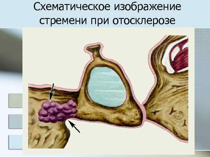 Схематическое изображение стремени при отосклерозе 