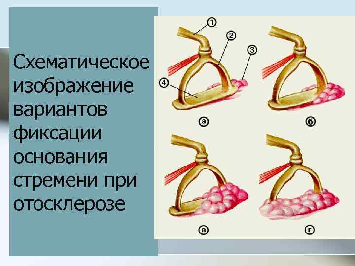 Схематическое изображение вариантов фиксации основания стремени при отосклерозе 