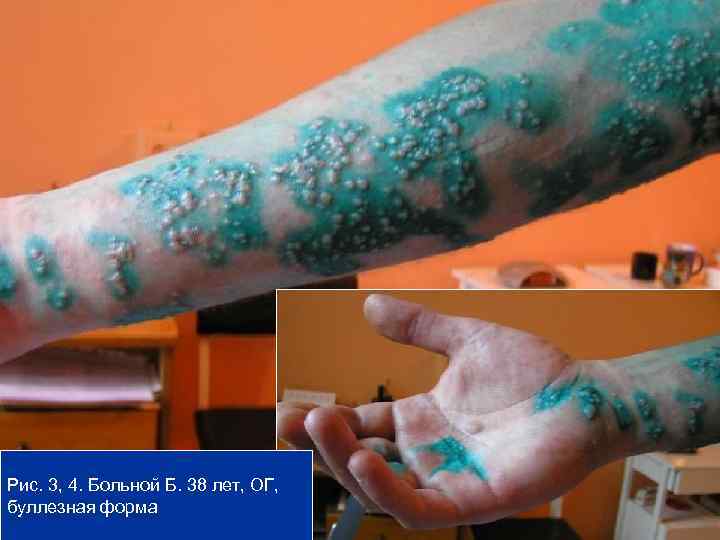 Рис. 3, 4. Больной Б. 38 лет, ОГ, буллезная форма 11 