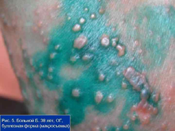Рис. 5. Больной Б. 38 лет, ОГ, буллезная форма (макросъемка) 12 