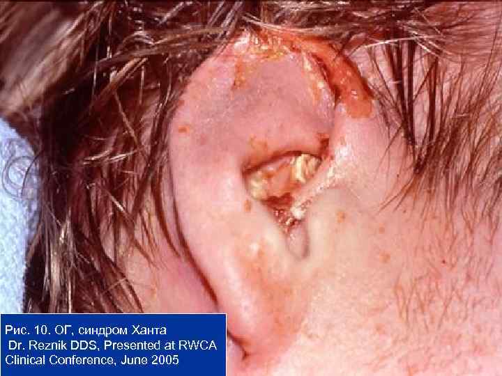 Рис. 10. ОГ, синдром Ханта Dr. Reznik DDS, Presented at RWCA Clinical Conference, June