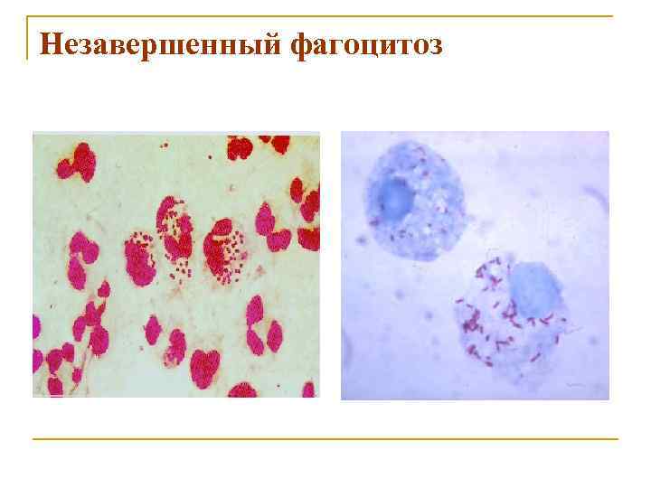 Туберкулез кокки. Завершенный фагоцитоз микробиология. Рисунок незавершенного фагоцитоза гонококков. Гонококки незавершенный фагоцитоз. Незавершенный фагоцитоз нейссерии гонореи.
