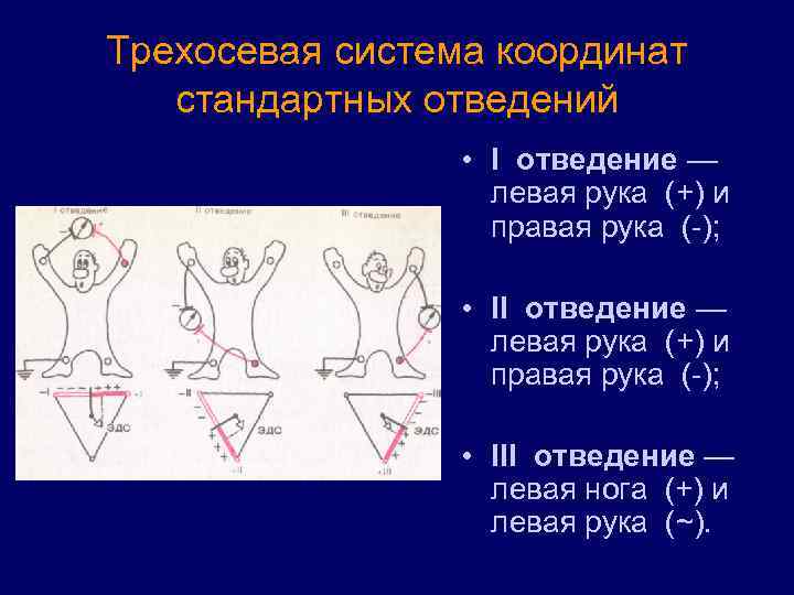 Трехосевая система координат стандартных отведений • I отведение — левая рука (+) и правая