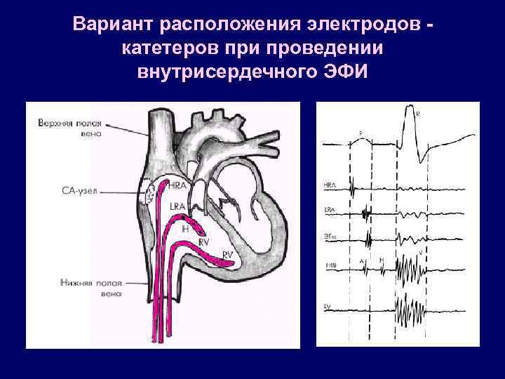 Холтер расположение электродов фото