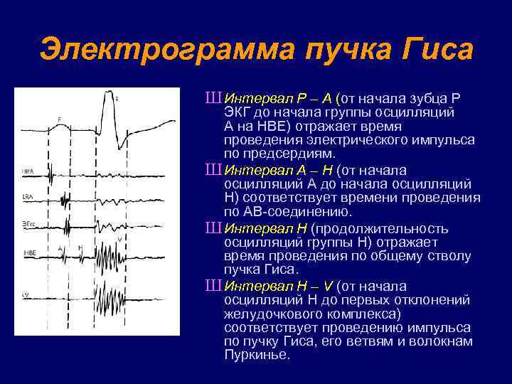 Электрограмма пучка Гиса Ш Интервал Р – А (от начала зубца Р ЭКГ до