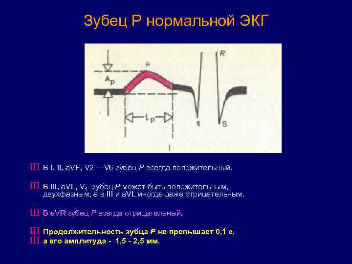Зубец Р нормальной ЭКГ Ш В I, II, a. VF, V 2 —V 6