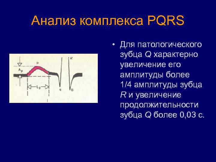 Анализ комплекса PQRS • Для патологического зубца Q характерно увеличение его амплитуды более 1/4