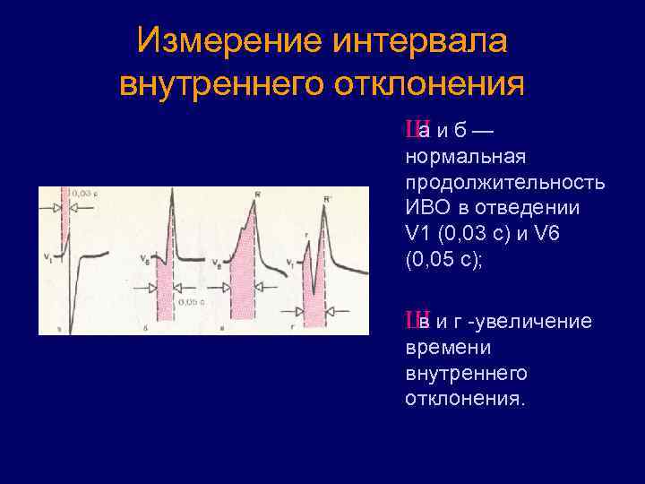 Измерение интервала внутреннего отклонения Ш а и б — нормальная продолжительность ИВО в отведении