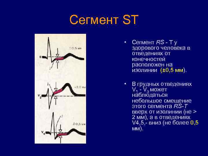 Сегмент ST • Сегмент RS - Т у здорового человека в отведениях от конечностей