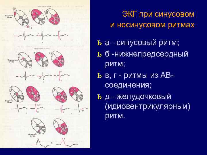 ЭКГ при синусовом и несинусовом ритмах ь ь а - синусовый ритм; б -нижнепредсердный
