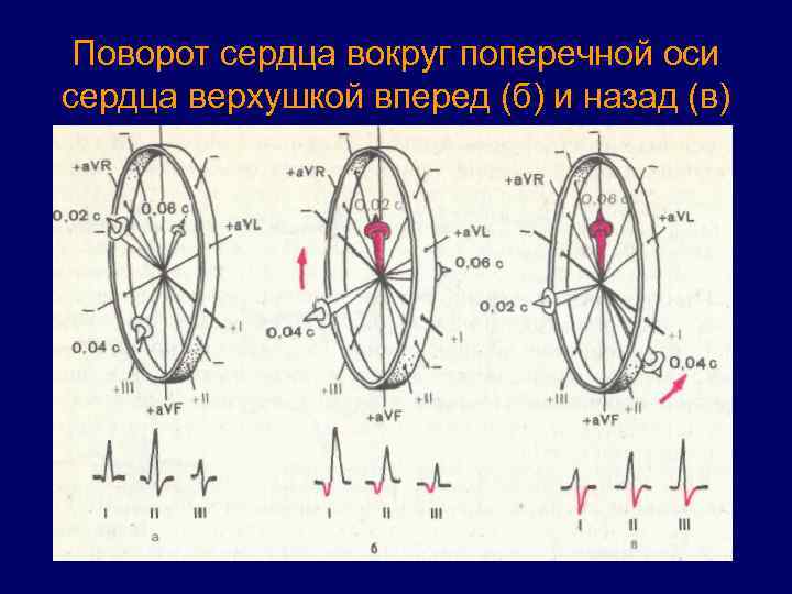 Поворот сердца вокруг поперечной оси сердца верхушкой вперед (б) и назад (в) 