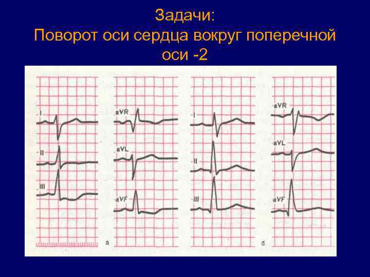 Задачи: Поворот оси сердца вокруг поперечной оси -2 