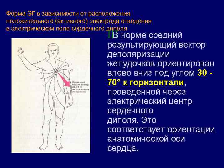 Форма ЭГ в зависимости от расположения положительного (активного) электрода отведения в электрическом поле сердечного