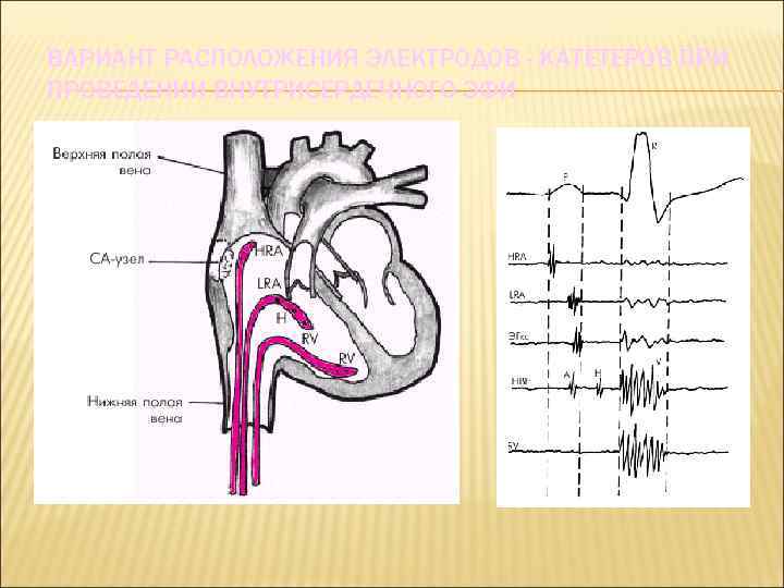 ВАРИАНТ РАСПОЛОЖЕНИЯ ЭЛЕКТРОДОВ - КАТЕТЕРОВ ПРИ ПРОВЕДЕНИИ ВНУТРИСЕРДЕЧНОГО ЭФИ 