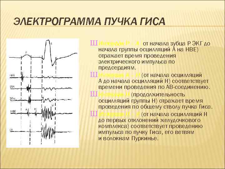 ЭЛЕКТРОГРАММА ПУЧКА ГИСА Ш Интервал Р – А (от начала зубца Р ЭКГ до