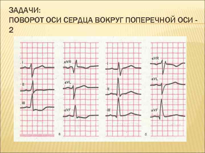 ЗАДАЧИ: ПОВОРОТ ОСИ СЕРДЦА ВОКРУГ ПОПЕРЕЧНОЙ ОСИ 2 