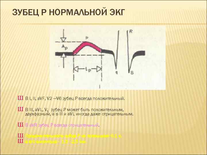 ЗУБЕЦ Р НОРМАЛЬНОЙ ЭКГ Ш В I, II, a. VF, V 2 —V 6