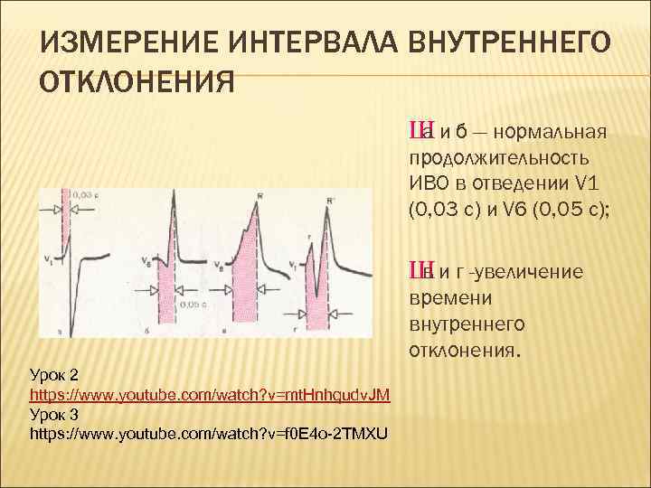 ИЗМЕРЕНИЕ ИНТЕРВАЛА ВНУТРЕННЕГО ОТКЛОНЕНИЯ Ш и б — нормальная а продолжительность ИВО в отведении