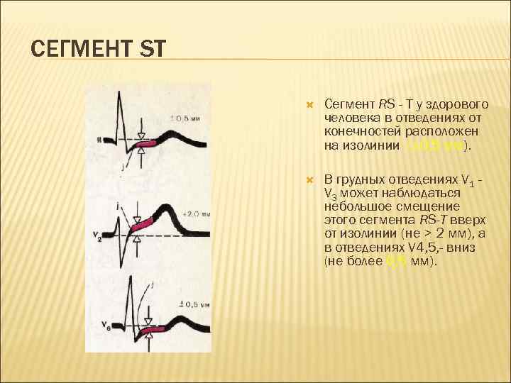 СЕГМЕНТ ST Сегмент RS - Т у здорового человека в отведениях от конечностей расположен