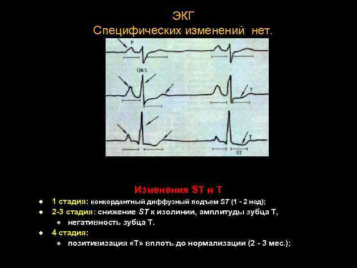 ЭКГ Специфических изменений нет. Изменения ST и T l l l 1 стадия: конкордантный