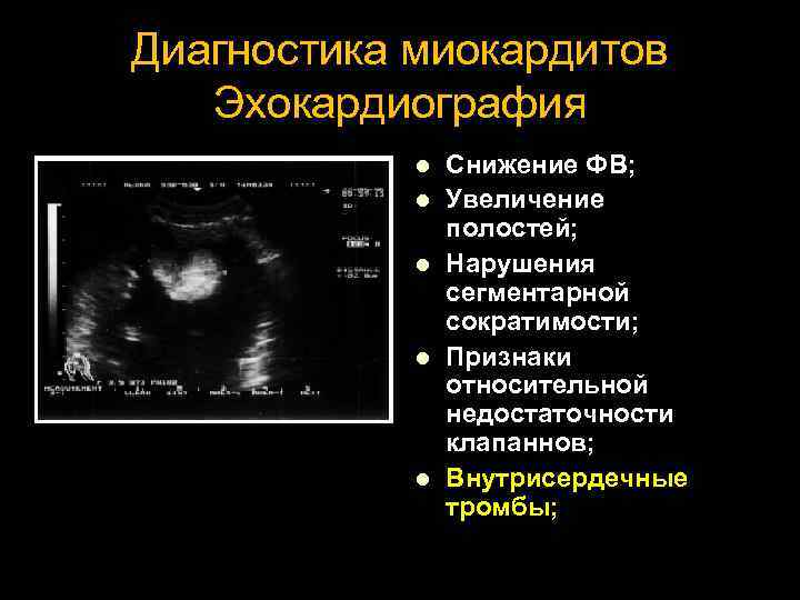 Диагностика миокардитов Эхокардиография l l l Снижение ФВ; Увеличение полостей; Нарушения сегментарной сократимости; Признаки