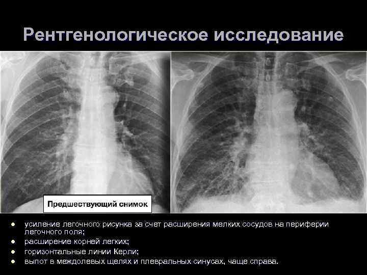 Рентгенологическое исследование l l усиление легочного рисунка за счет расширения мелких сосудов на периферии