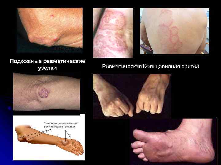 Подкожные ревматические узелки Ревматическая Кольцевидная эритеа 