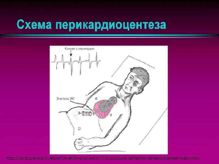 http: //cardioplaneta. ru/expert/video/manipulation/115 -punkciya-perikardiocentez-video. html 