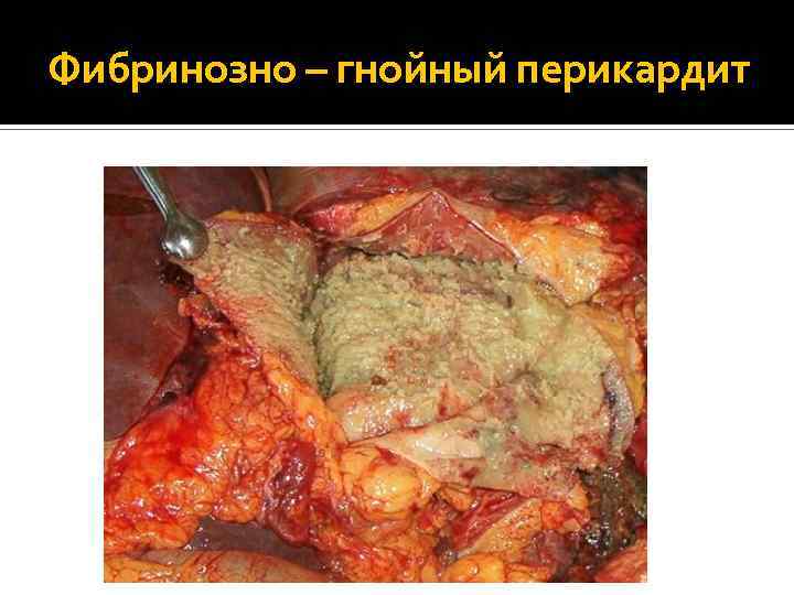 Фибринозно – гнойный перикардит 