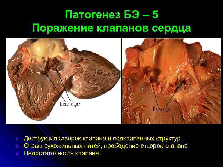 Патогенез БЭ – 5 Поражение клапанов сердца ь Деструкция створок клапана и подклапанных структур