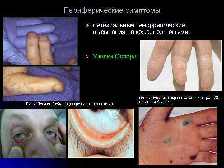 Периферические симптомы Ø петехиальные геморрагические высыпания на коже, под ногтями. Ø Узелки Ослера: Пятна