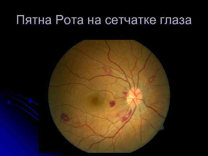 Пятна Рота на сетчатке глаза 